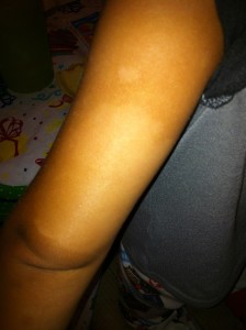 Psoriasis on skin is almost gone. Taken on July 30, 12-weeks of being on a low-sals diet