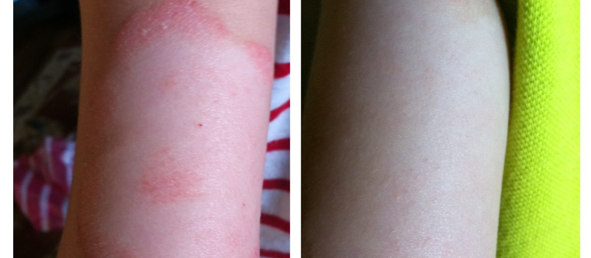 Reversing My Son's Psoriasis
