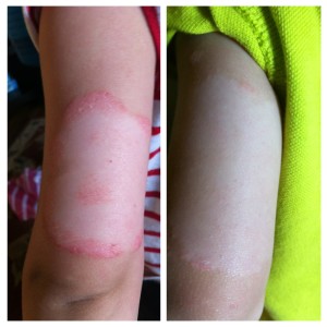 Psoriasis on back of arm Picture on the right taken 2 weeks after being sals-free